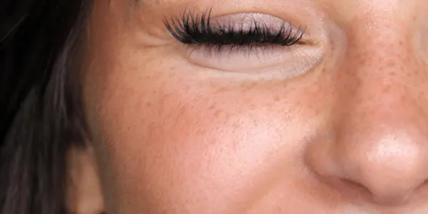 Formation privée des taches de rousseur