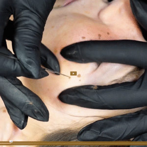 Formation Taches de rousseur