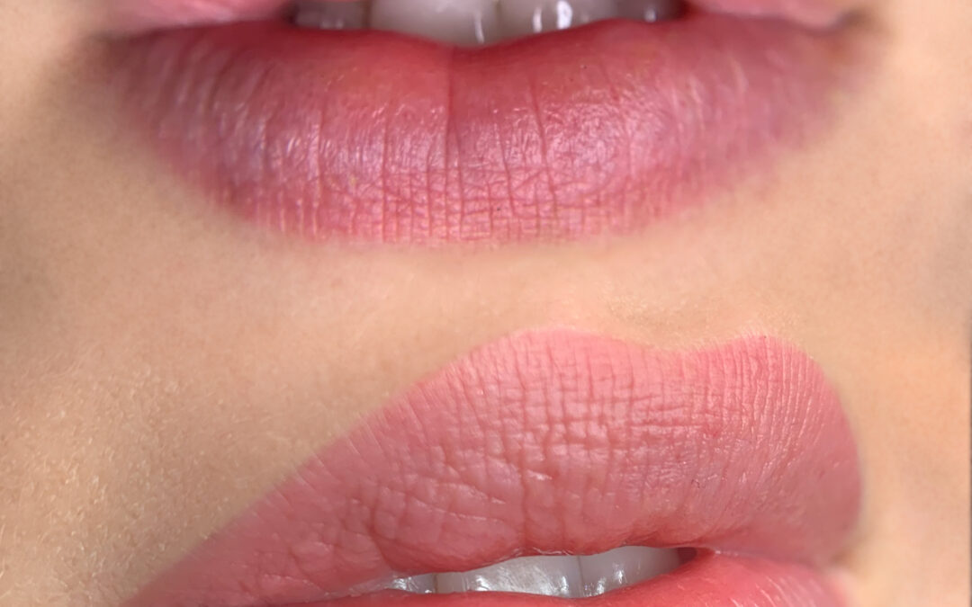 Pigmentation de la bouche effet “lipstick”